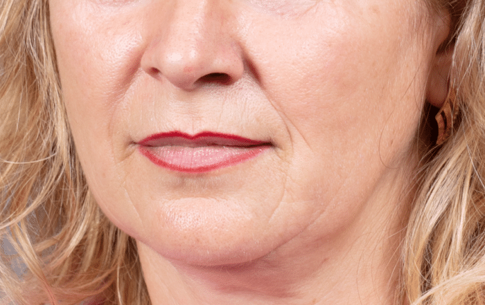 Middle-aged woman with signs of facial sagging