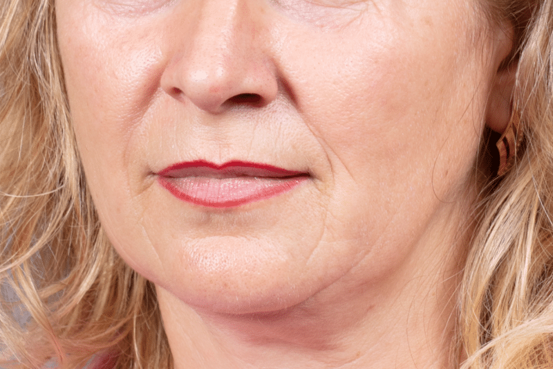 Middle-aged woman with signs of facial sagging