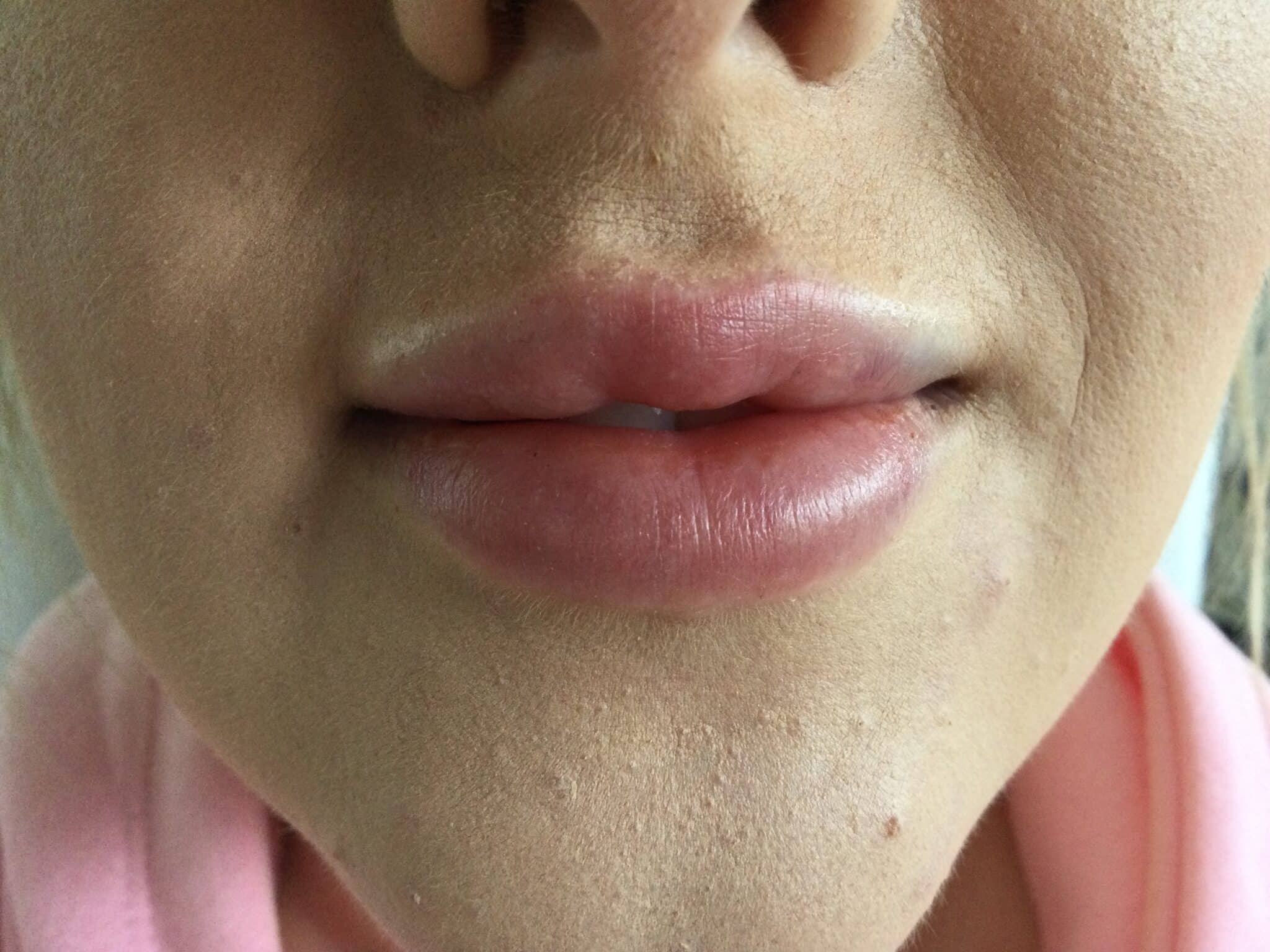 After 1 ml lip filler to plump the lips