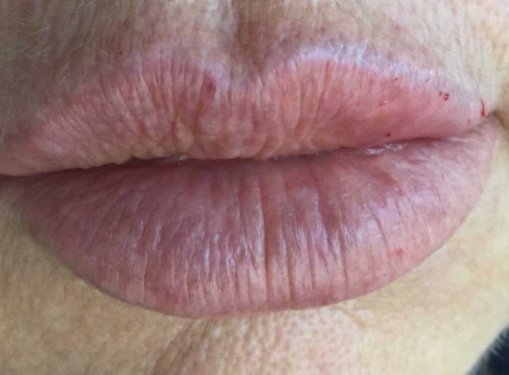 After 1 ml lip filler to reshape the lips