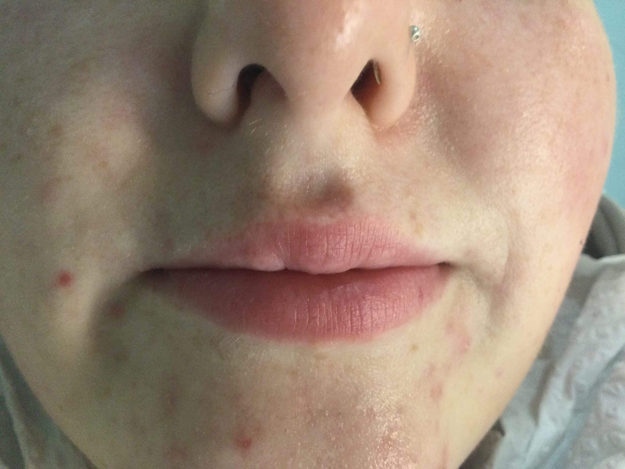 Before 1 ml lip filler to plump the lips