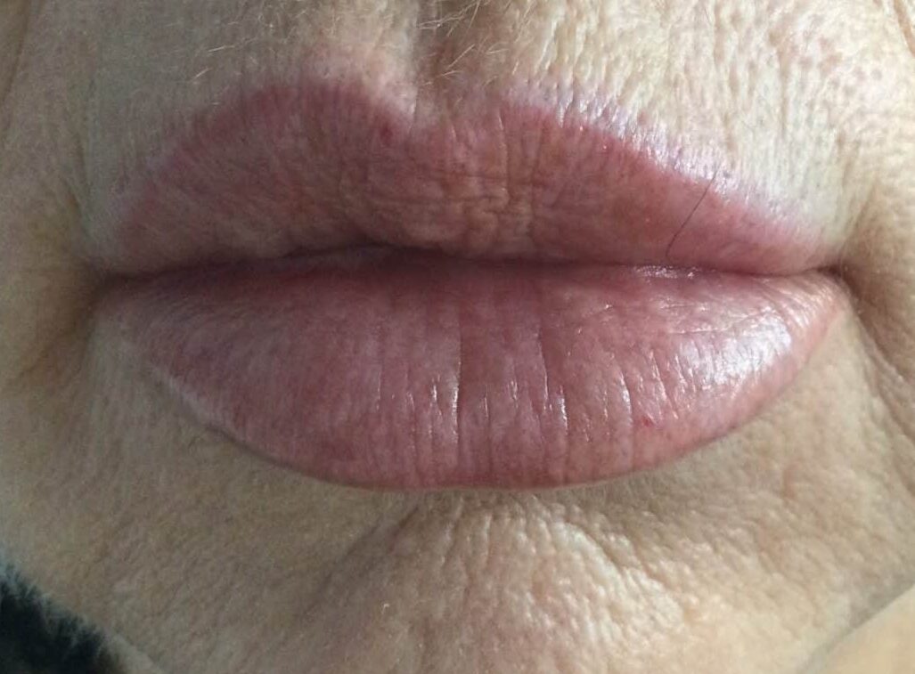 Before 1 ml lip filler to reshape the lips