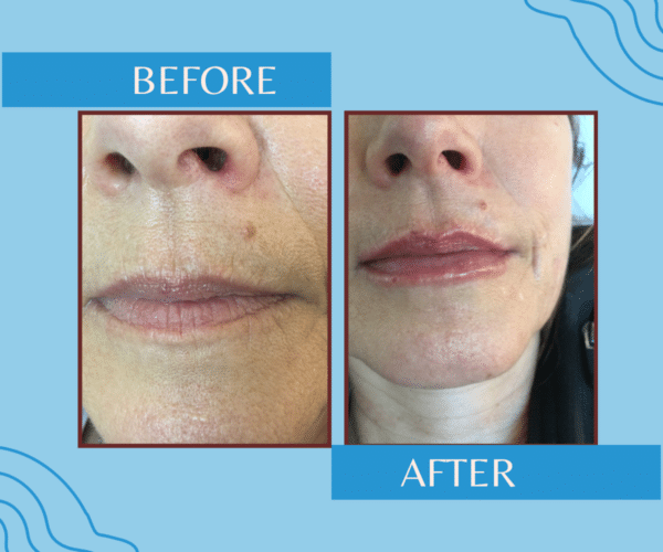 50 year old woman before and after lip filler