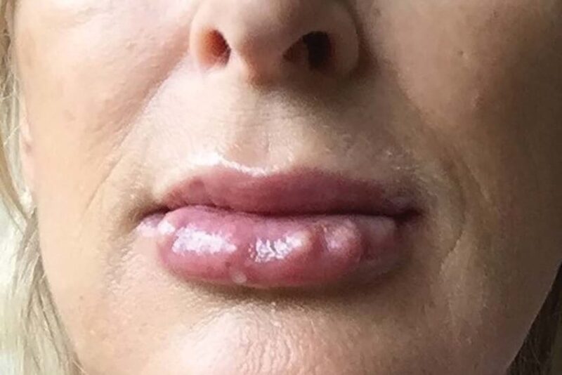 Juvederm and lip nodules after 4 months