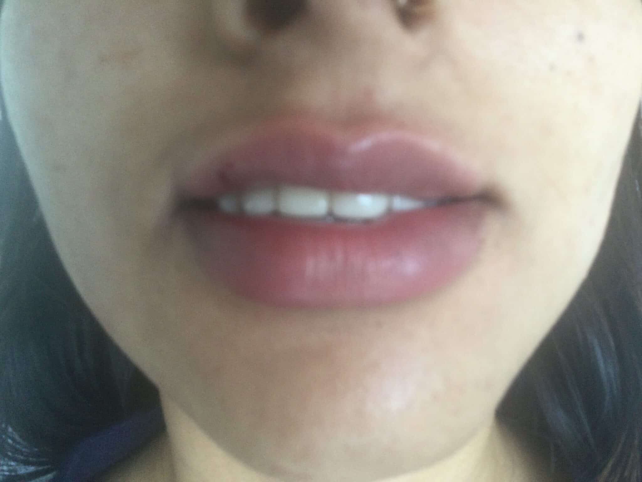 Improved lip shape after lip filler