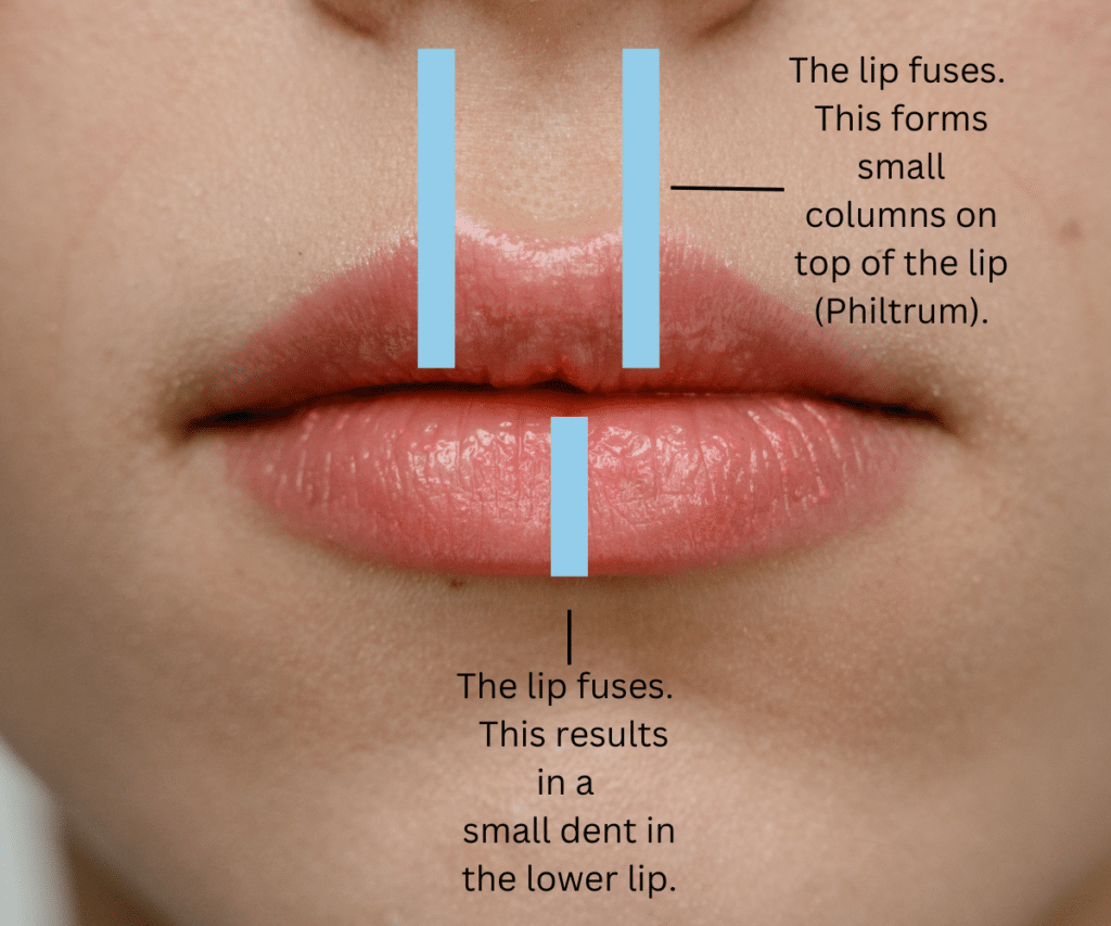 Lip Fusion Points