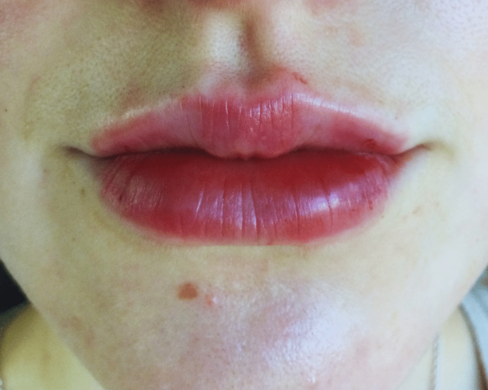 After Lip Filler, Satini Cosmetic Clinic, Christchurch