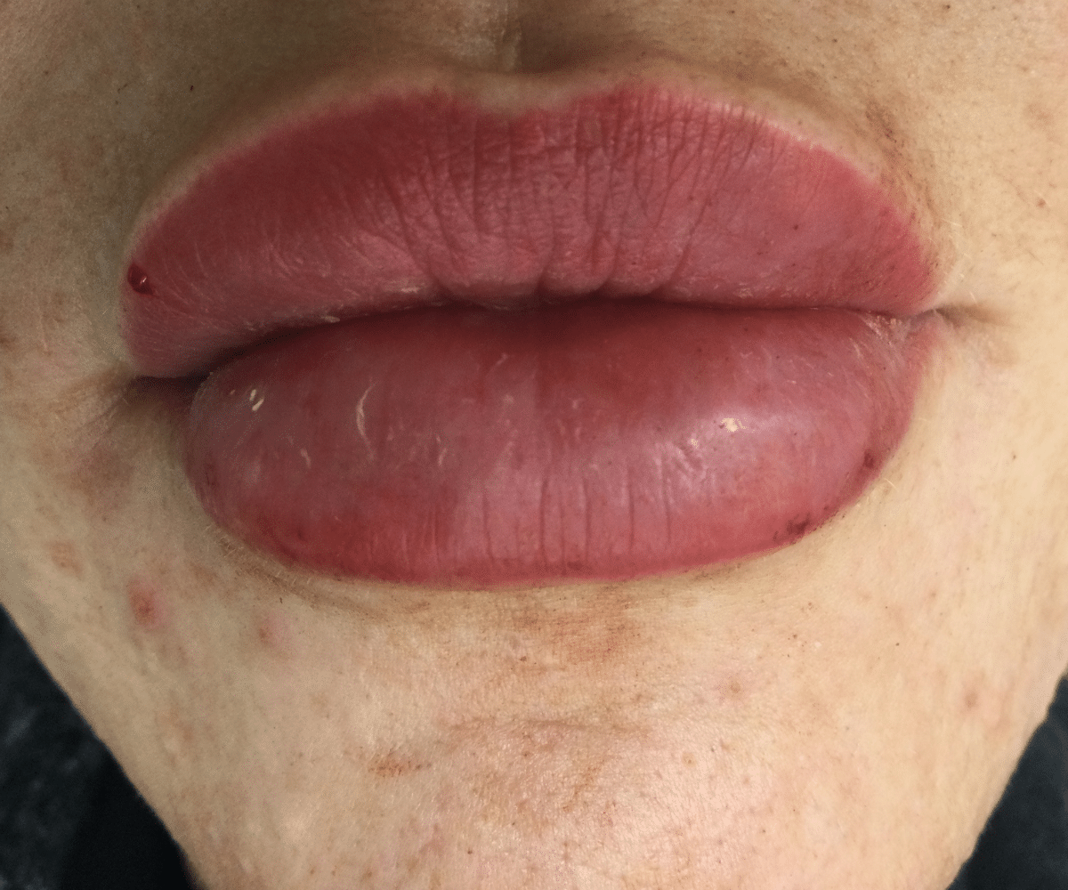 Unnatural-looking lip after lip filler that was wrongly placed