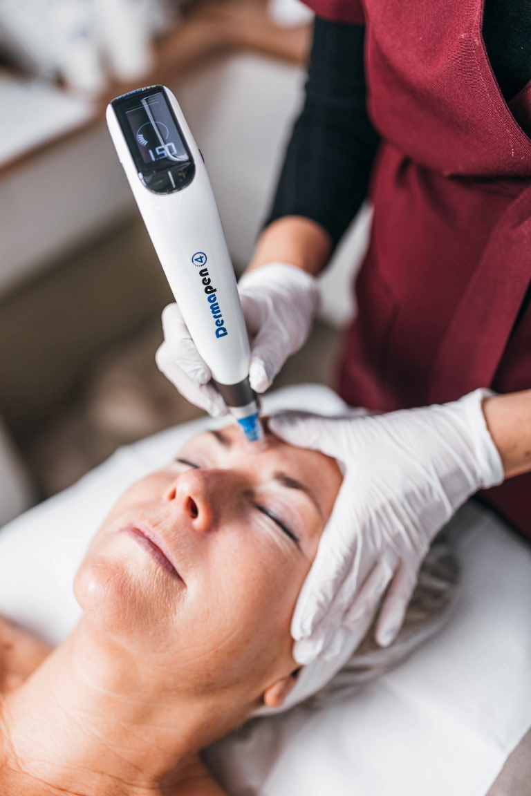 Dermapen microneedling