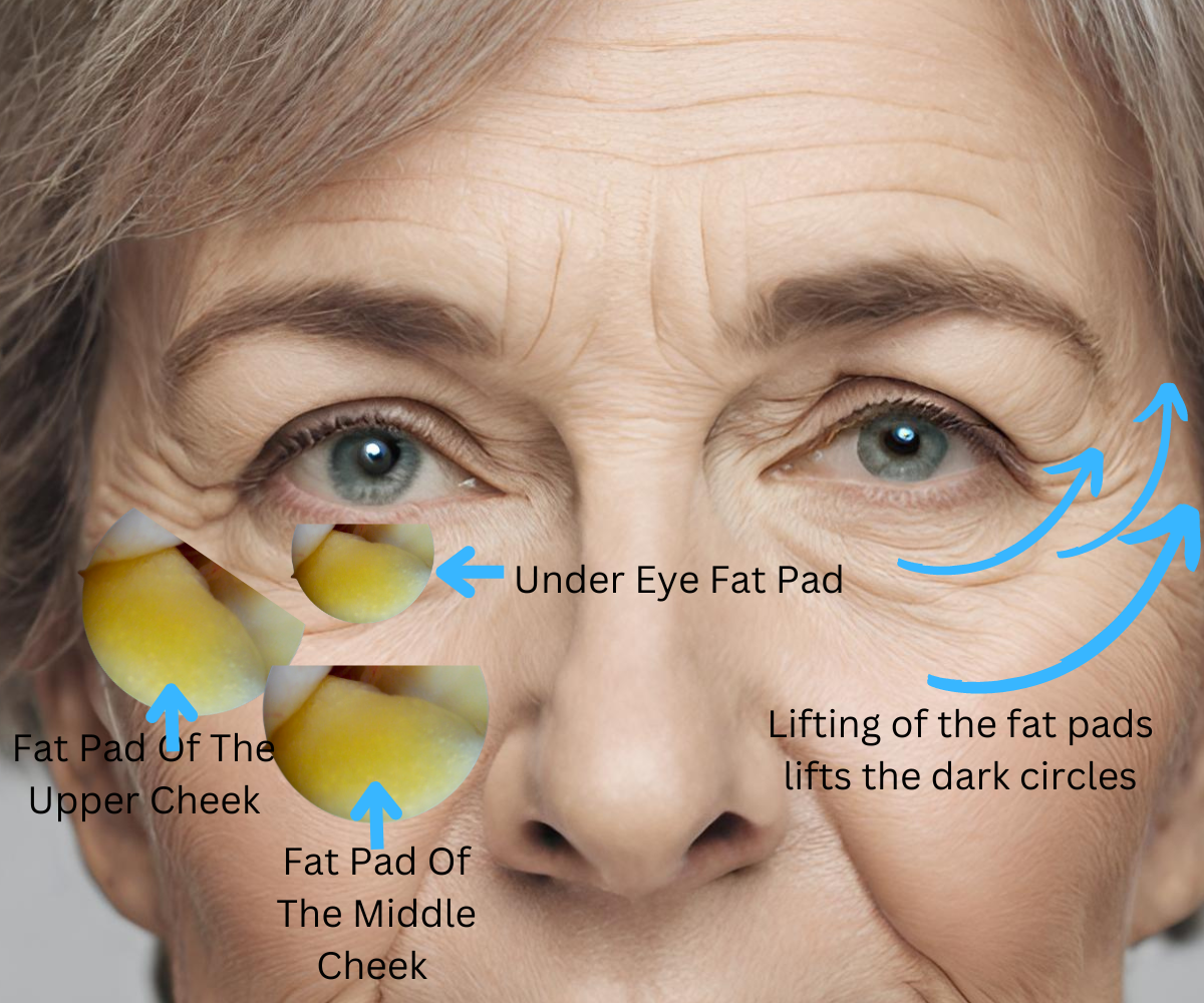 Lift fat pads around the eyes with dermal filler