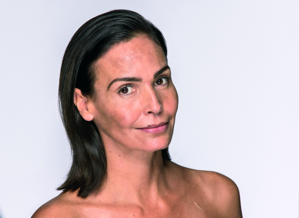 Dermamelan Model with melasma and uneven pigmentation