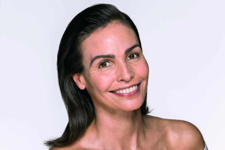 Smiling Dermamelan Model with melasma and uneven pigmentation