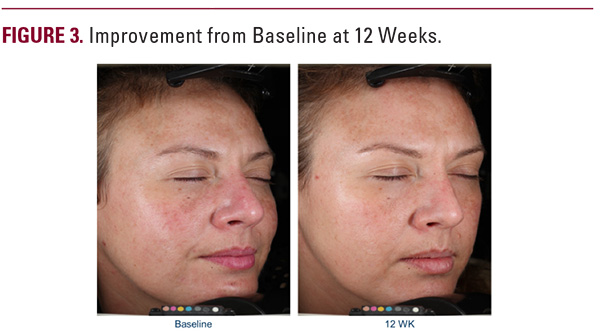 Improved uneven pigmentation over 12 weeks with non-hydroquinone cream