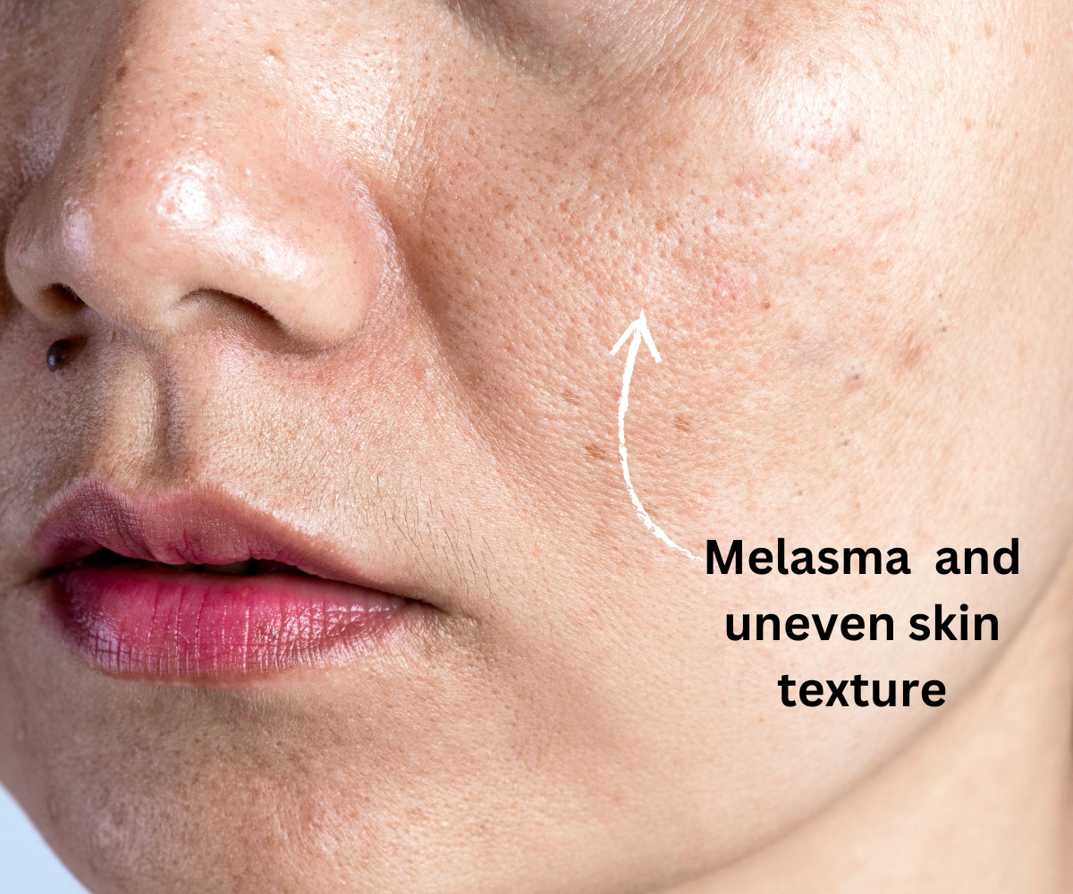 Melasma and uneven skin texture