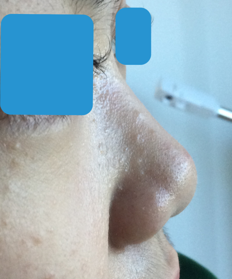 Before PDO Threads For Flat Nasal bridge