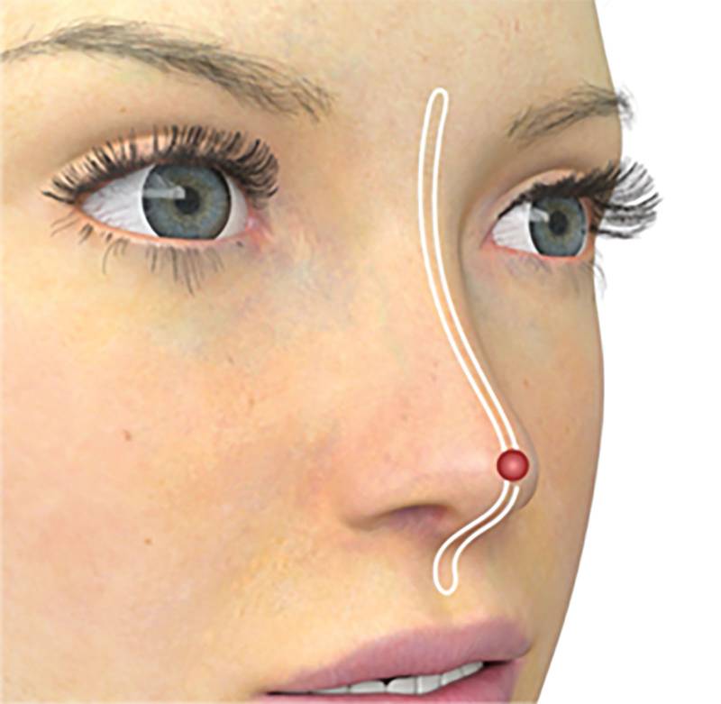 Nose thread lift at Satini Cosmetic Clinic