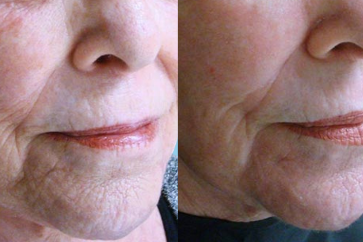 Before And After Dark Spot Treatment with IPL and Prescription Cream-Satini Cosmetic clinic-Christchurch