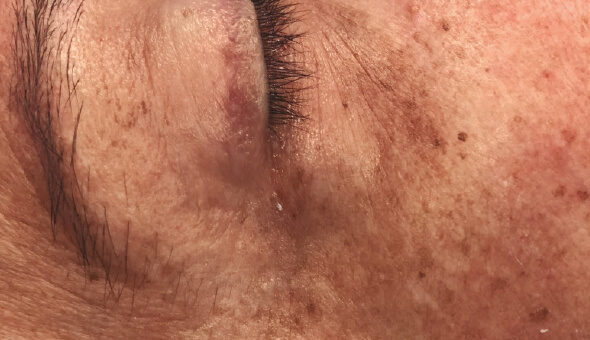 After Chemcial Peel for Eye Rejuvenation