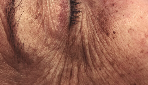 Eye rejuvenation with professional peel