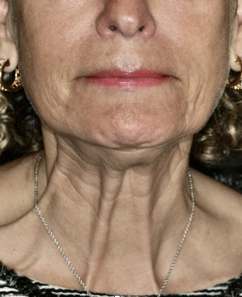 Mature woman with neck bands