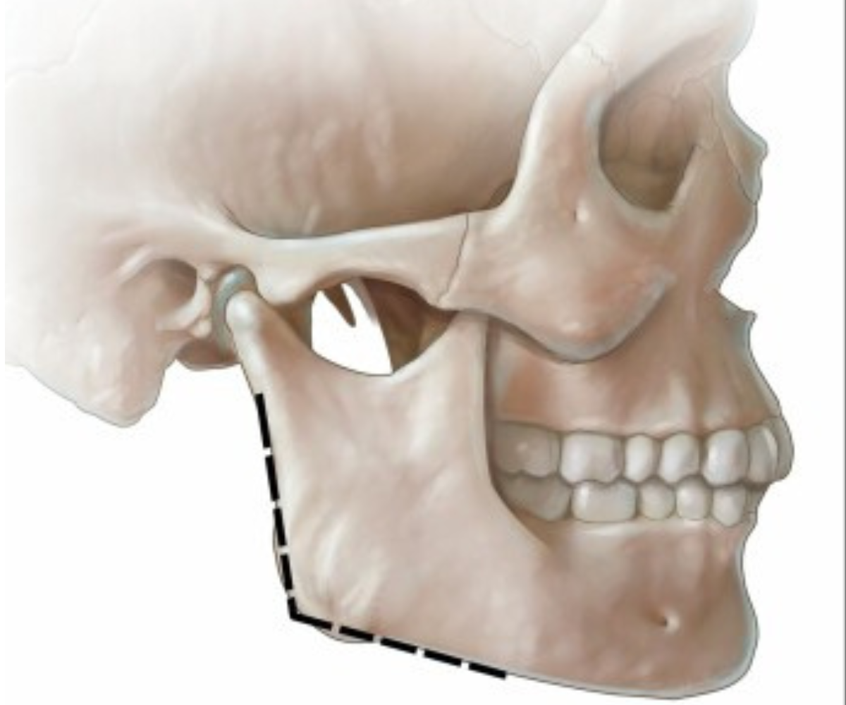 Bony changes of the jawline as we age