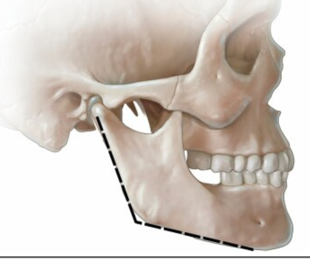 Bony changes of the jaw line due to ageing