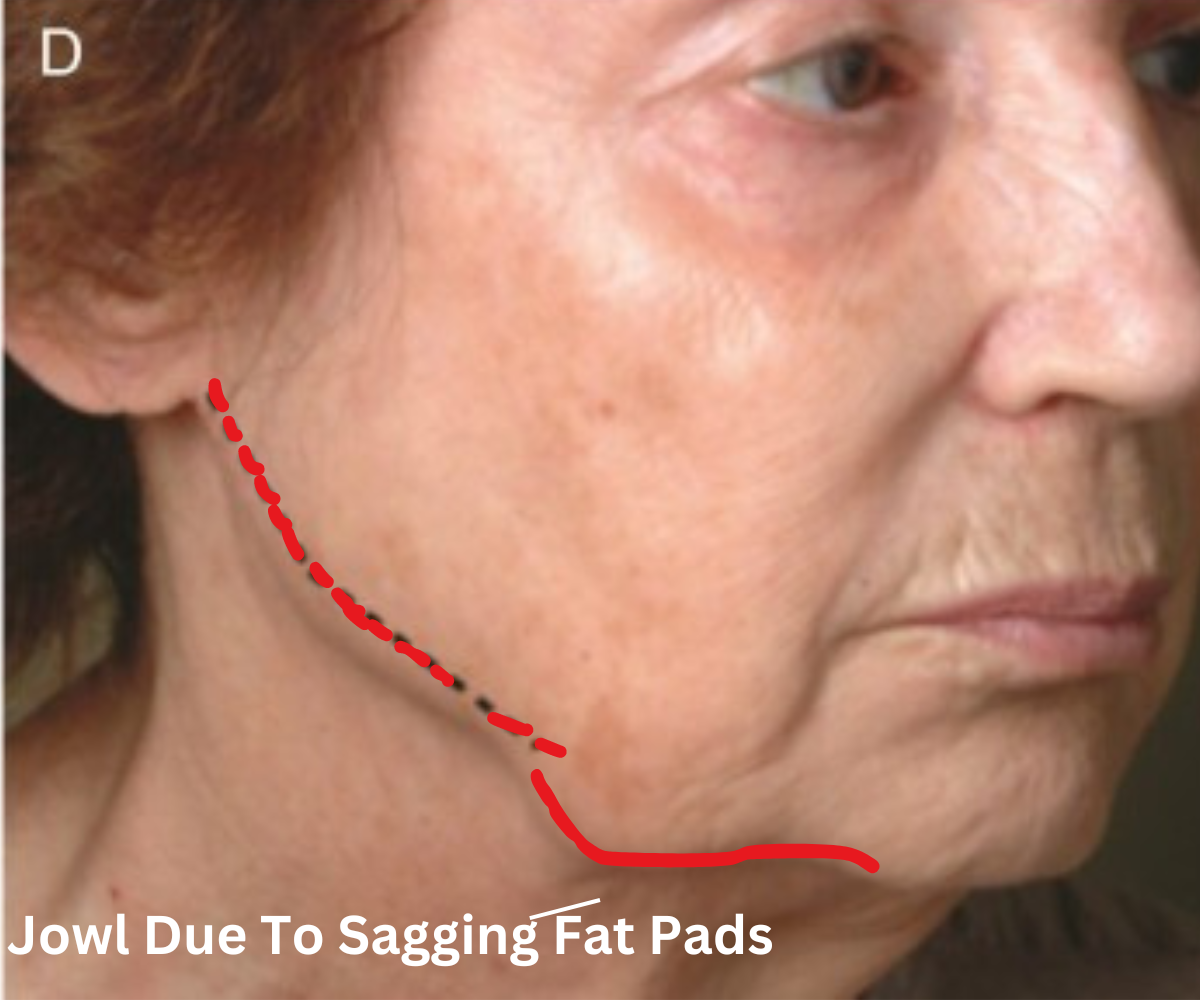 Jowl Due To Sagging Fat Pads