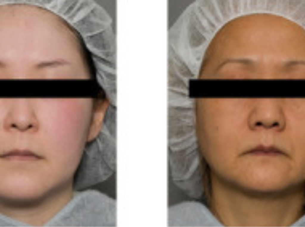 Dull Skin In Younger And Older Woman