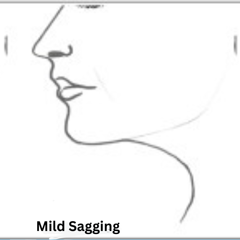 Mild neck sagging