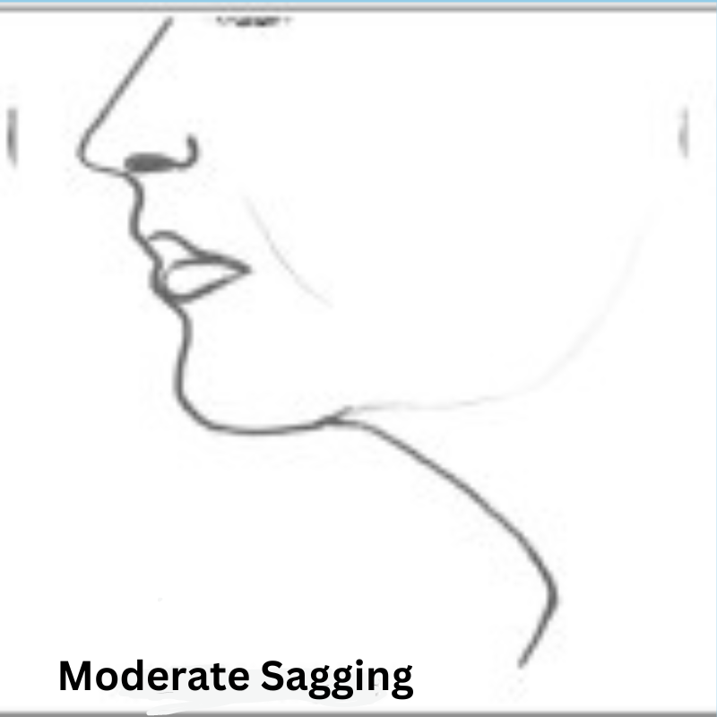 Moderate neck sagging