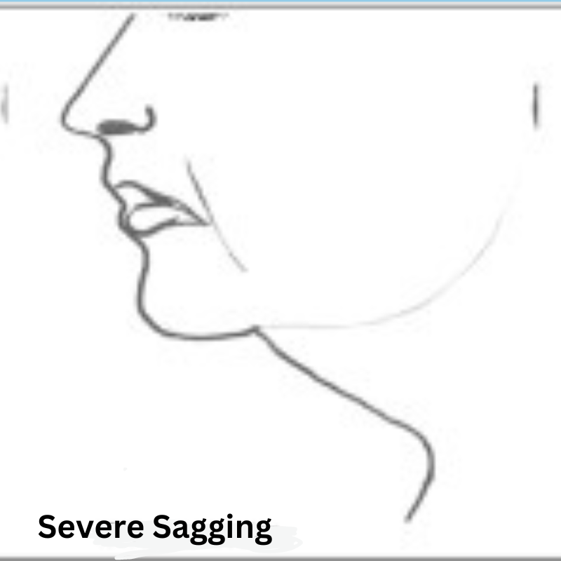 Severe neck sagging