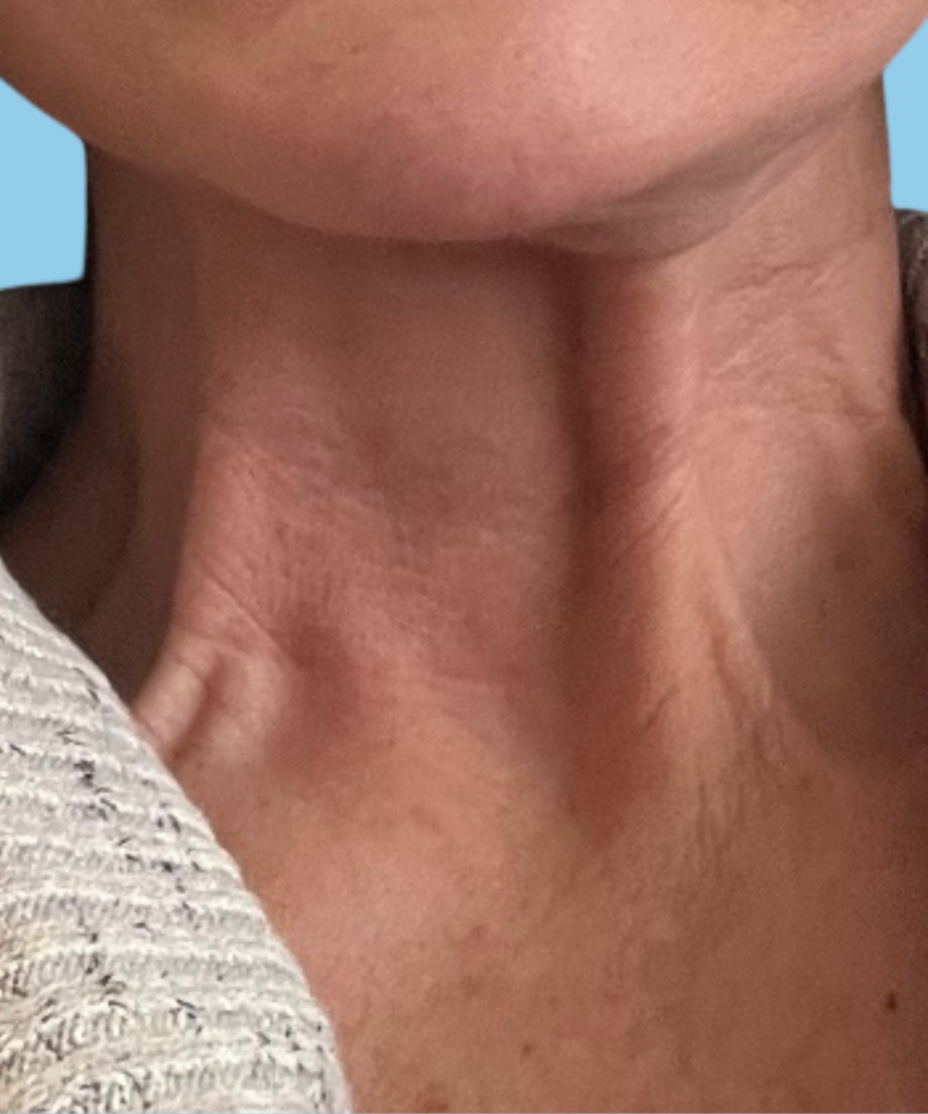 Platysma bands neck