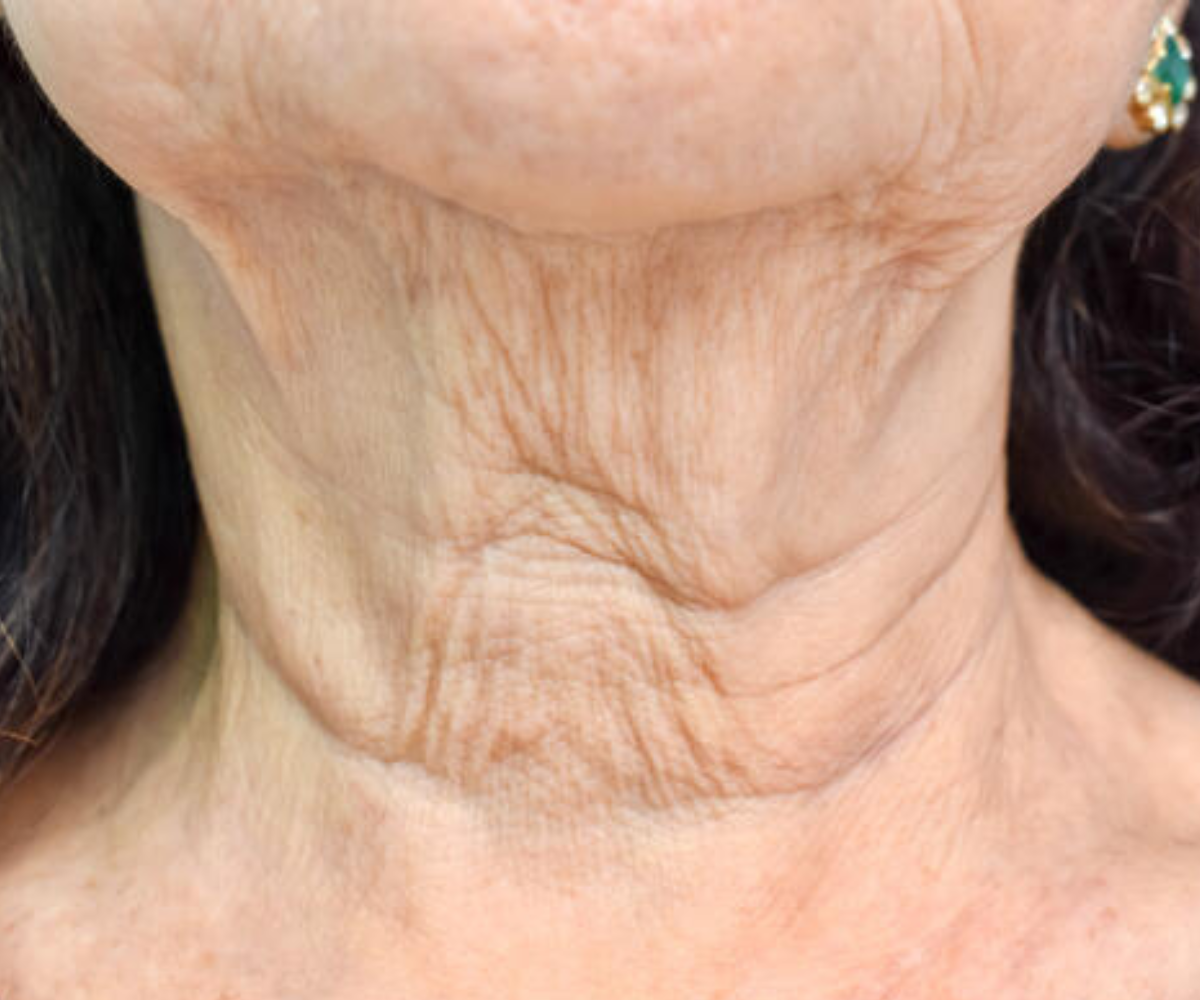 Neck wrinkles in mature woman