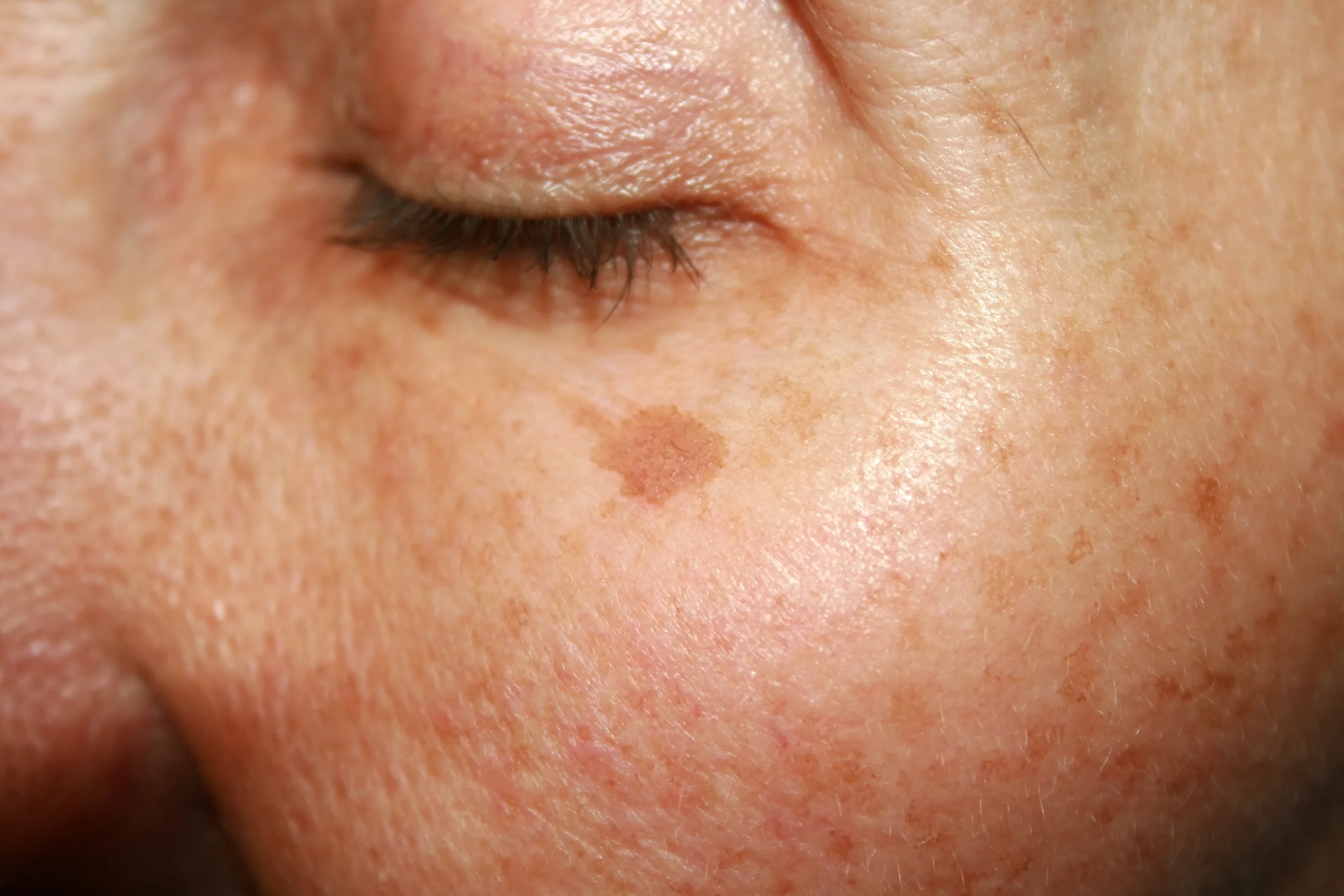 Dark Spots Skin