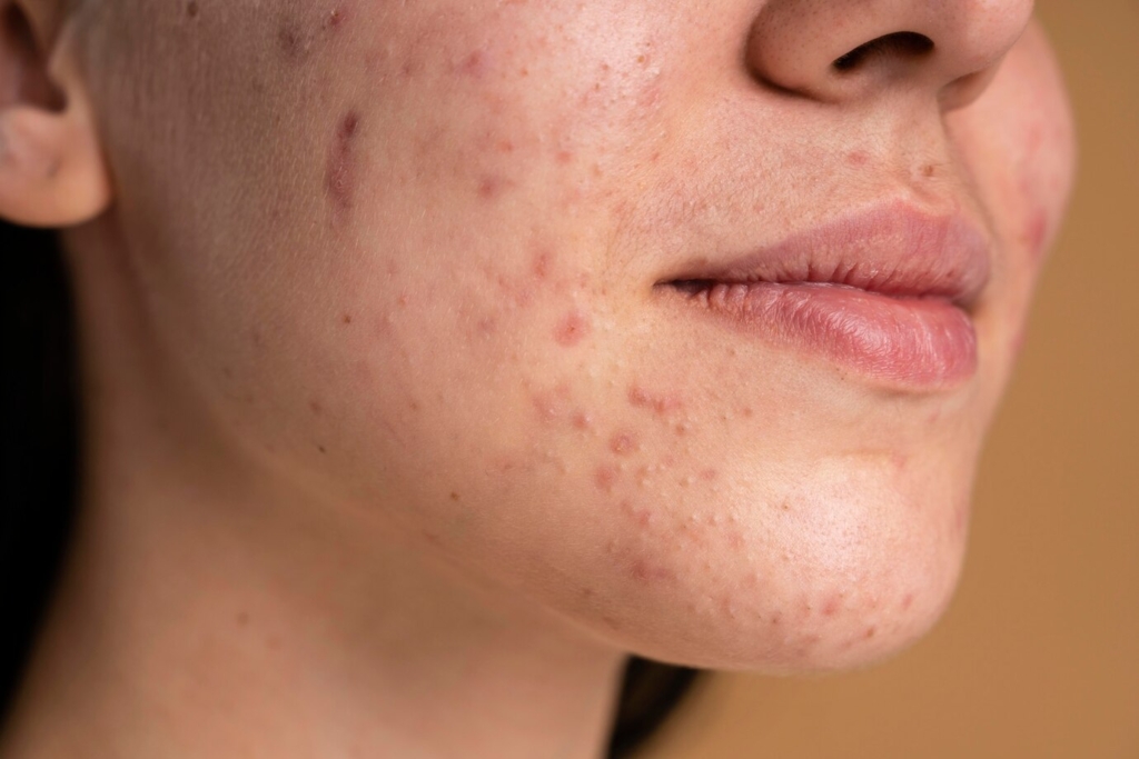 Confident Young Woman with signs of acne