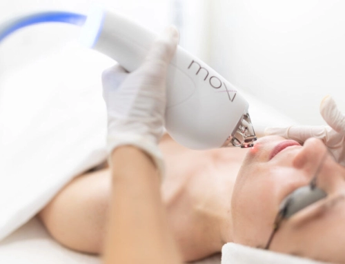 BBL Photofacial & MOXI Laser Treatments – Are they any good?