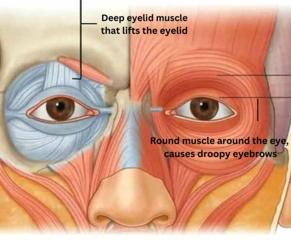 Muscle responsible for droopy eyelids after Botox Eyebrow lift