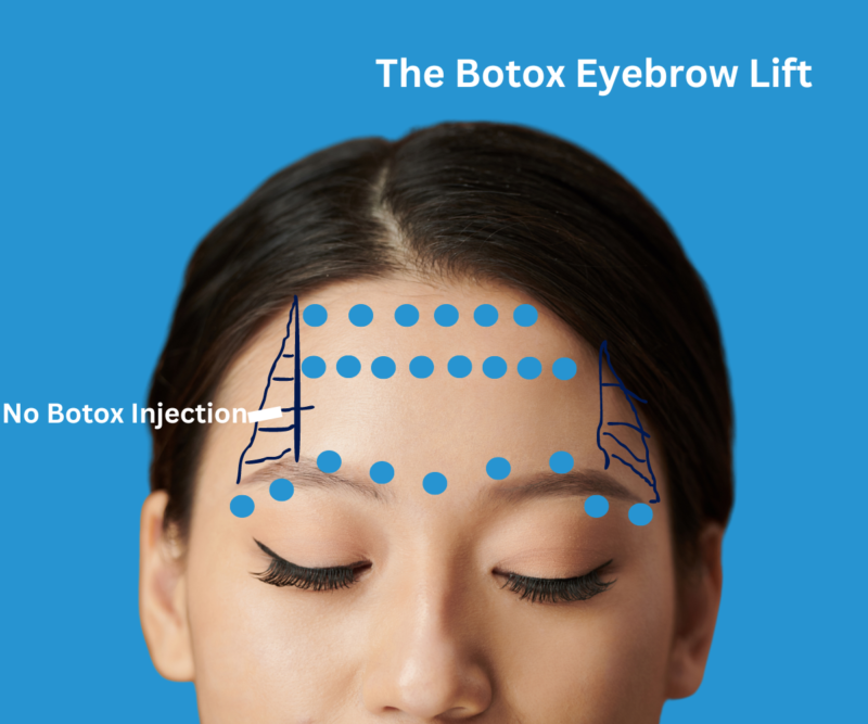 The Botox Eyebrow Lift