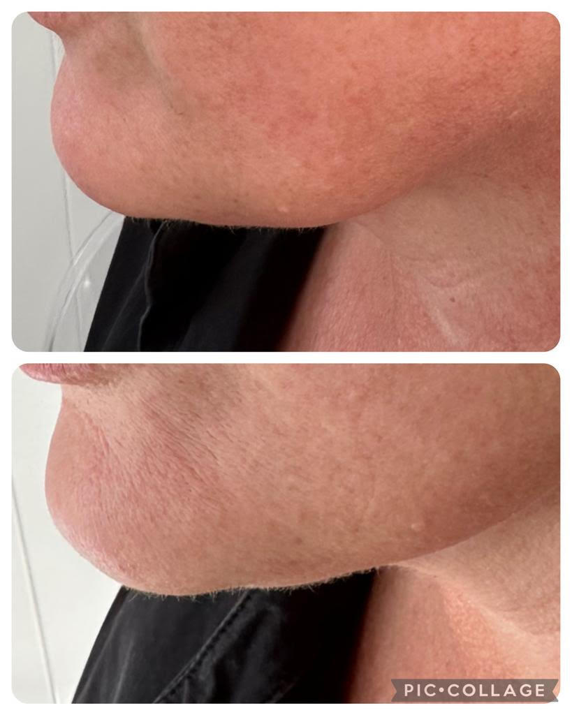 Jawline post dermal filler