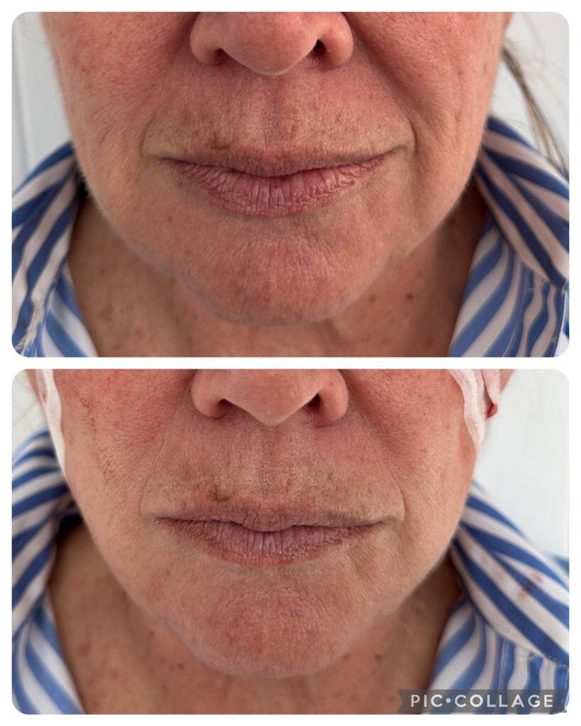 Before And After Dermal Filler To Improve Nasolabial Folds