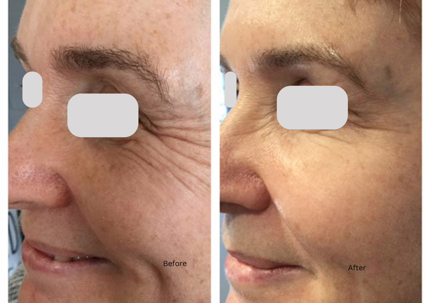 7c7c6e03-1ed2-45d8-8d76-67f5ce0184d5 52 year old woman before and after Crow's feet Botox