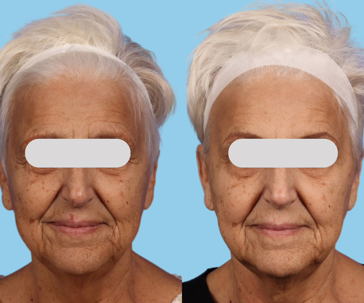 c059f223-42ad-4674-a4a3-aff9b37bd2c4 73 year old woman before and after Botox for the forehead lines, frown lines and crows feet