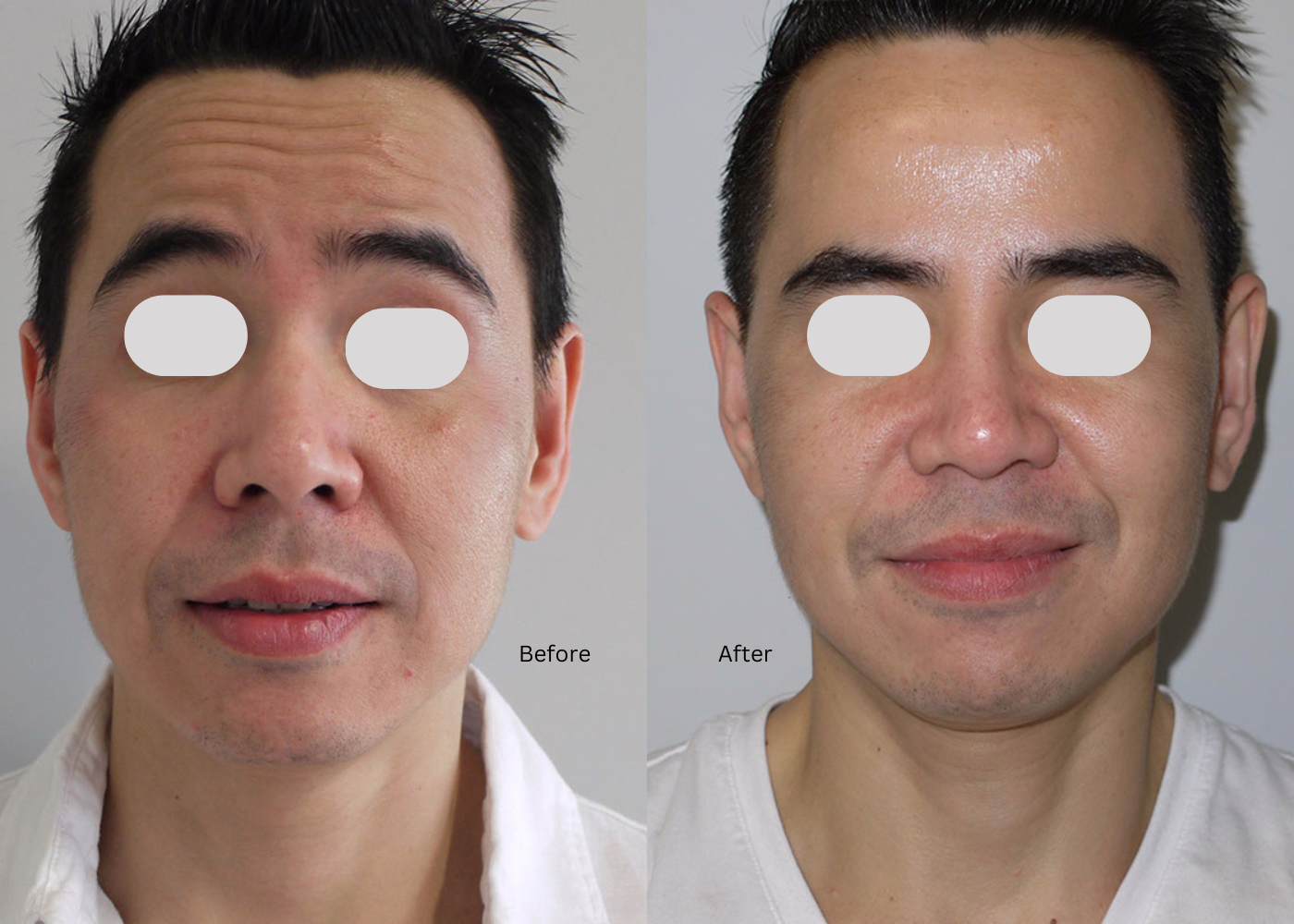 dfbaed84-3cbf-460a-9c43-454973df3bfc Before and after Botox for frown lines and forehead lines