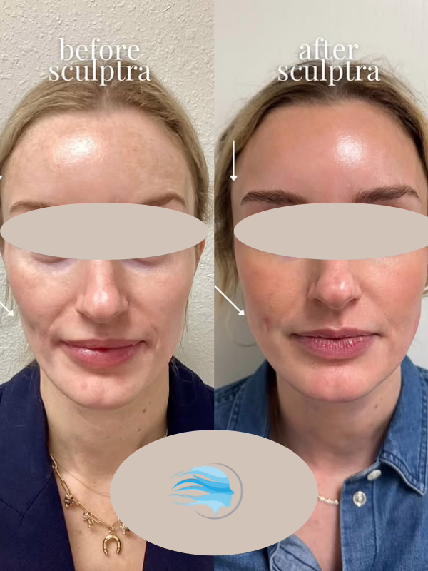 Sculptra before and after result at Satini Cosmetic Clinic