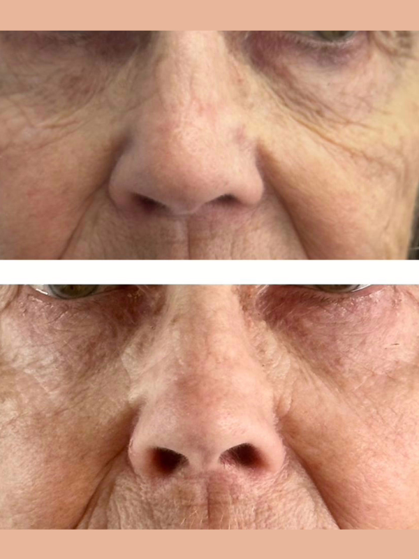 Sunekos before And After, Nasolabial Folds