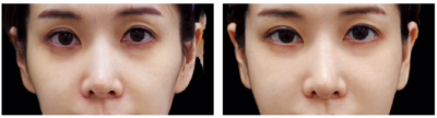 Improvement dark circel Rejuran for the under-eye area