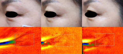 Rejuran B And A Rejuran Before And After Images For Crow's feet