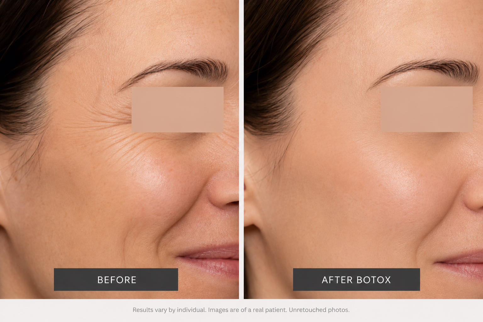 Before And After Botox for Crows Feet Before And After Botox for Crows Feet