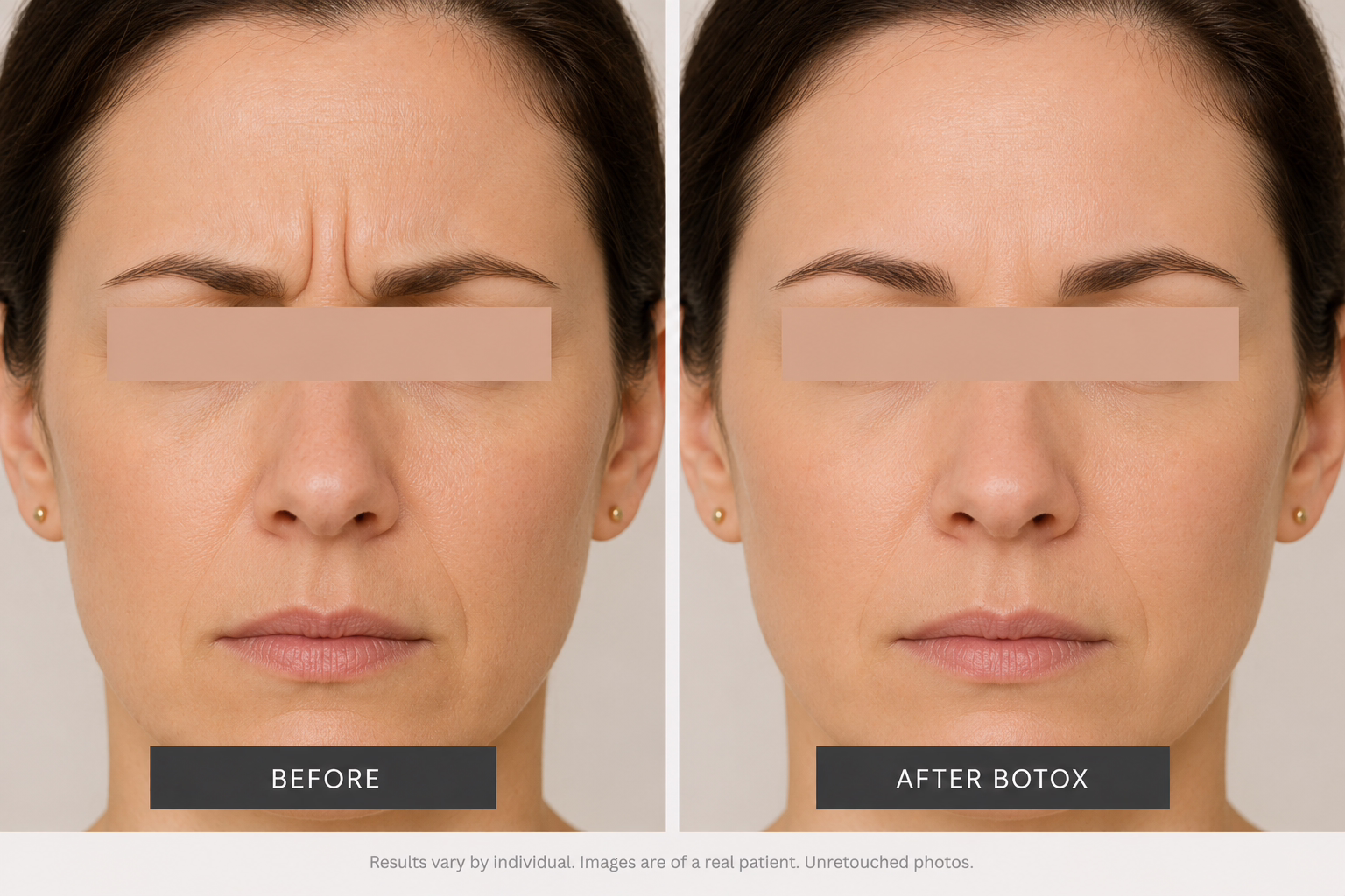 Before And After Botox For Frown Lines Before And After Botox For Frown Lines