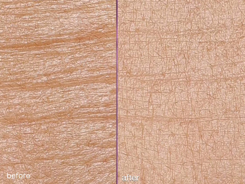 Before And After An Advanced Skin Treatment Before And After An Advanced Skin Treatment